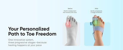 Silicone Bunion Alignment System